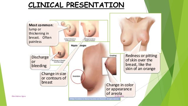Breast Cancer In Pregnancy