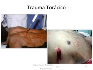 Instituto Superior Tecnológico
Cruz
Roja Ecuatoriana
113
Trauma Torácico
 