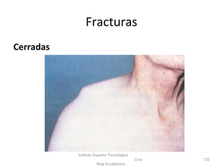 Cerradas
Instituto Superior Tecnológico
Cruz
Roja Ecuatoriana
122
Fracturas
 