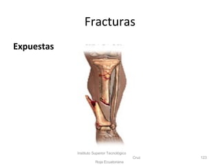 Expuestas
Instituto Superior Tecnológico
Cruz
Roja Ecuatoriana
123
Fracturas
 
