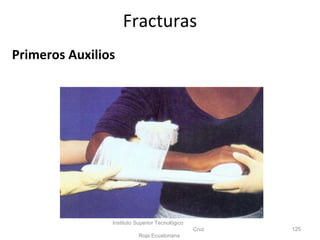 Primeros Auxilios
Instituto Superior Tecnológico
Cruz
Roja Ecuatoriana
125
Fracturas
 