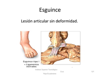 Esguince
Lesión articular sin deformidad.
Instituto Superior Tecnológico
Cruz
Roja Ecuatoriana
127
 
