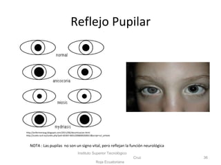 Reflejo Pupilar
Instituto Superior Tecnológico
Cruz
Roja Ecuatoriana
36
http://enfermeriaug.blogspot.com/2011/06/decorticacion.html
http://scielo.isciii.es/scielo.php?pid=S0365-66912008000200013&script=sci_arttext
NOTA : Las pupilas no son un signo vital, pero reflejan la función neurológica
 