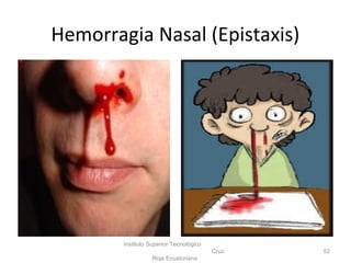 Hemorragia Nasal (Epistaxis)
Instituto Superior Tecnológico
Cruz
Roja Ecuatoriana
52
 