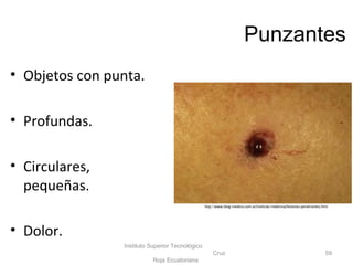 Punzantes
• Objetos con punta.
• Profundas.
• Circulares,
pequeñas.
• Dolor.
Instituto Superior Tecnológico
Cruz
Roja Ecuatoriana
59
http://www.blog-medico.com.ar/noticias-medicina/lesiones-penetrantes.htm
 