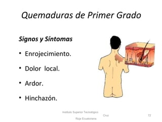 Quemaduras de Primer Grado
Signos y Síntomas
• Enrojecimiento.
• Dolor local.
• Ardor.
• Hinchazón.
Instituto Superior Tecnológico
Cruz
Roja Ecuatoriana
72
 
