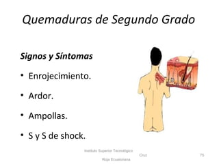 Quemaduras de Segundo Grado
Signos y Síntomas
• Enrojecimiento.
• Ardor.
• Ampollas.
• S y S de shock.
Instituto Superior Tecnológico
Cruz
Roja Ecuatoriana
75
 