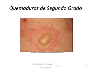 Instituto Superior Tecnológico
Cruz
Roja Ecuatoriana
76
http://www.nlm.nih.gov/medlineplus/spanish/ency/esp_imagepages/1829.htm
Quemaduras de Segundo Grado
 