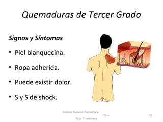 Quemaduras de Tercer Grado
Signos y Síntomas
• Piel blanquecina.
• Ropa adherida.
• Puede existir dolor.
• S y S de shock.
Instituto Superior Tecnológico
Cruz
Roja Ecuatoriana
78
 