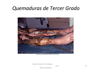 Instituto Superior Tecnológico
Cruz
Roja Ecuatoriana
79
http://www.pix8.net/pro/pic/14898vHJEa/693299.jpg
Quemaduras de Tercer Grado
 