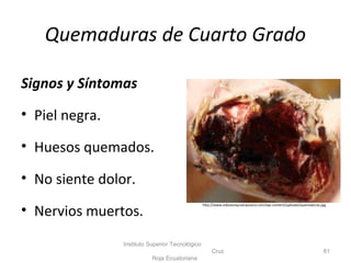 Quemaduras de Cuarto Grado
Signos y Síntomas
• Piel negra.
• Huesos quemados.
• No siente dolor.
• Nervios muertos.
Instituto Superior Tecnológico
Cruz
Roja Ecuatoriana
81
http://www.vidasanaycuerposano.com/wp-content/uploads/quemaduras.jpg
 