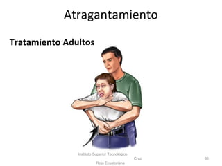 Tratamiento Adultos
Instituto Superior Tecnológico
Cruz
Roja Ecuatoriana
86
Atragantamiento
 