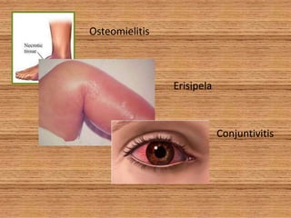 OsteomielitisErisipelaConjuntivitis