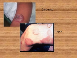 CarbuncoLepra