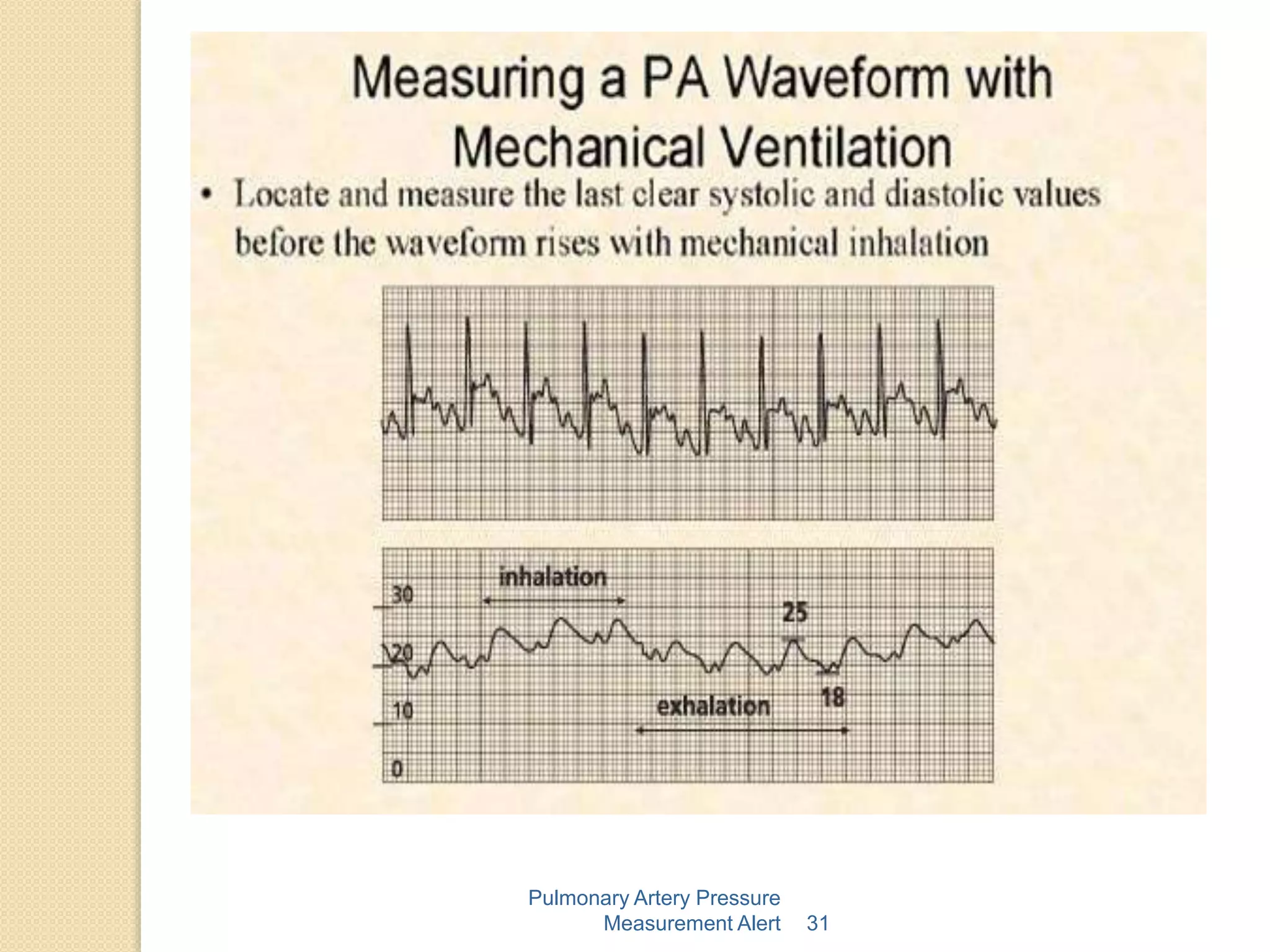 Pa catheter ctvac | PPTX