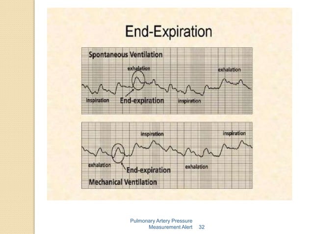 Pa catheter ctvac | PPTX | Heart and Cardiovascular Diseases | Diseases ...