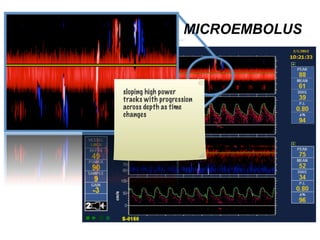 MICROEMBOLUS 
sloping high power 
tracks with progression 
across depth as time 
changes 
 