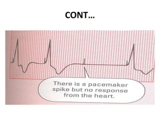 Pacemaker Beeping Pacemaker | PPTX