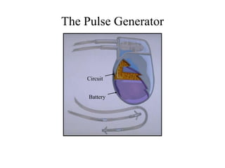 Artificial Cardiac Pacemaker | PPTX
