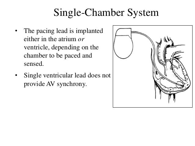 Single versus double chamber pacemaker Single chamber vs dual chamber exhaust - Kounenki-girl
