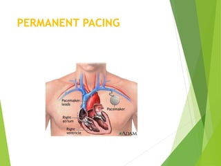 Pacing Definition Pacemaker Pacemaker | PPTX