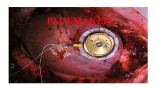 PACEMAKER
 
