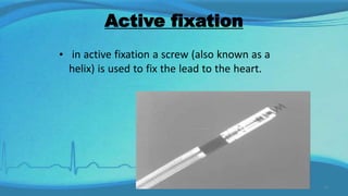 Pacemaker | PPTX