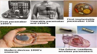 Pacemaker | PPTX