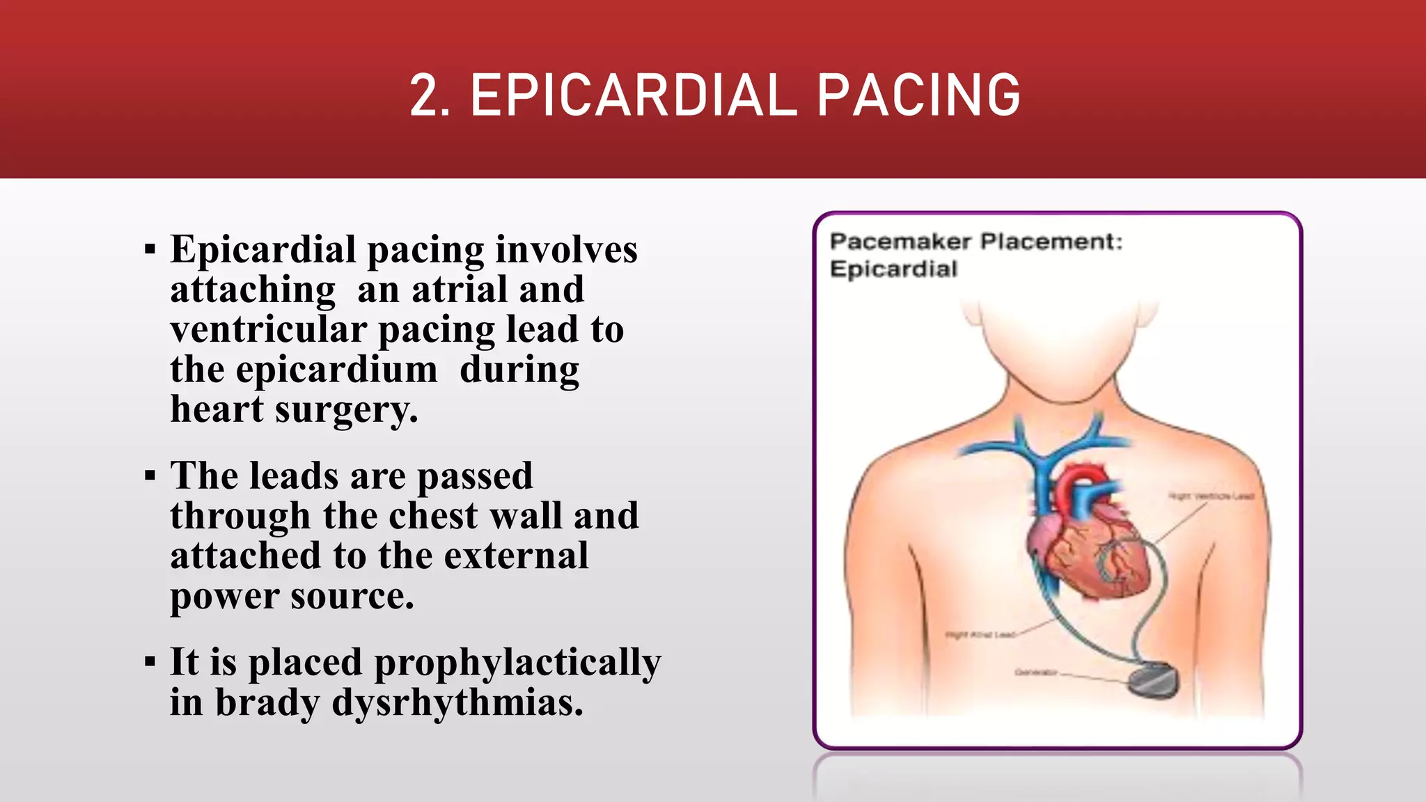 Paediatric Pacemaker Position PACEMAKER | PDF