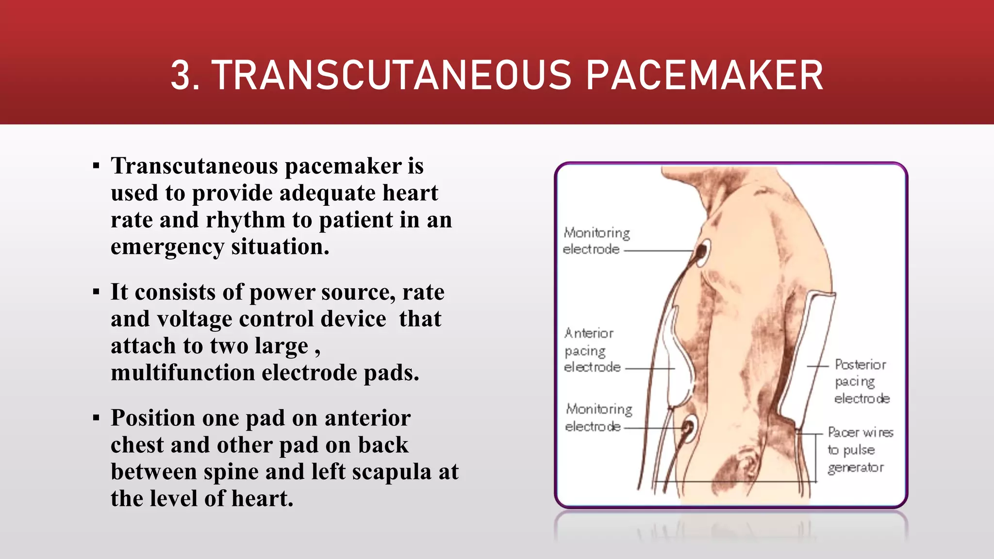PACEMAKER | PDF