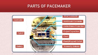 PACEMAKER | PDF