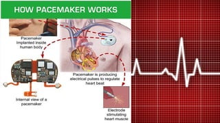 PACEMAKER | PDF