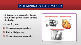 PACEMAKER | PDF
