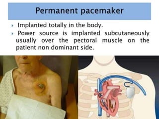 Bio-Medical Therapeutic of in Pacemaker& Respiratory | PPTX