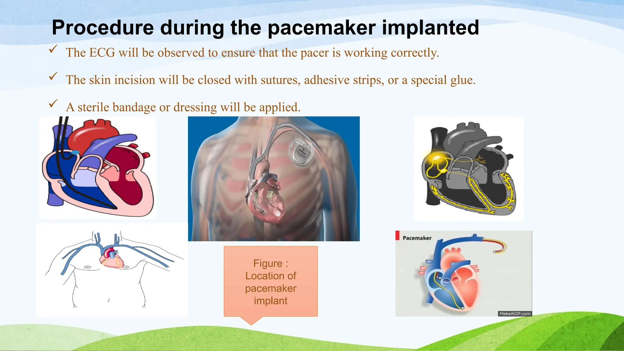 Procedure during the pacemaker implanted
 The ECG will be observed to ensure that the pacer is working correctly.
 The skin incision will be closed with sutures, adhesive strips, or a special glue.
 A sterile bandage or dressing will be applied.
Figure :
Location of
pacemaker
implant
 