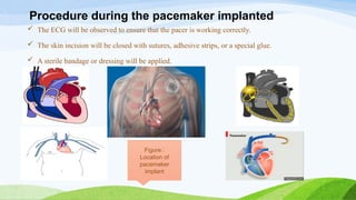 cardiac pacemaker internal cardiac device | PPTX