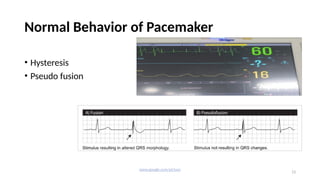 Pacemaker.pptx.dr.samir.pptxhhhhhhhhhhhhhh | PPTX