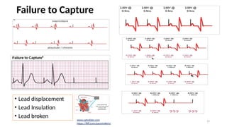 Pacemaker.pptx.dr.samir.pptxhhhhhhhhhhhhhh | PPTX