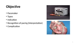 Pacing Definition Pacemaker Pacemaker.pptx.dr.samir.pptxhhhhhhhhhhhhhh | PPTX