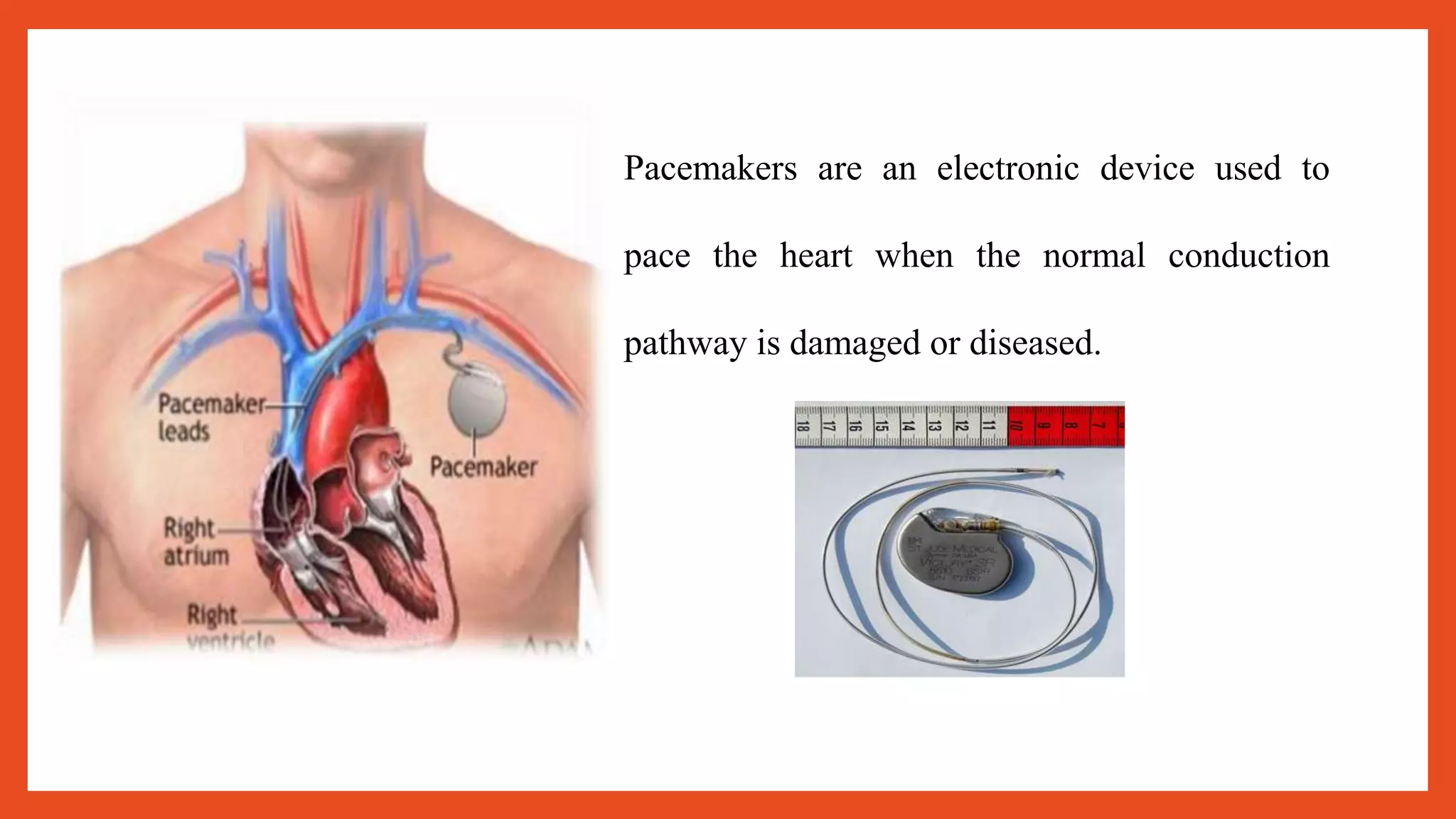 Pacemaker Gsce Notes Pacemaker | PPTX