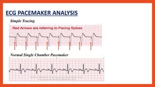 Pacemaker Analysis Programming Pacemaker | PPTX