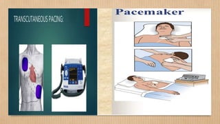 Pacemaker | PPTX