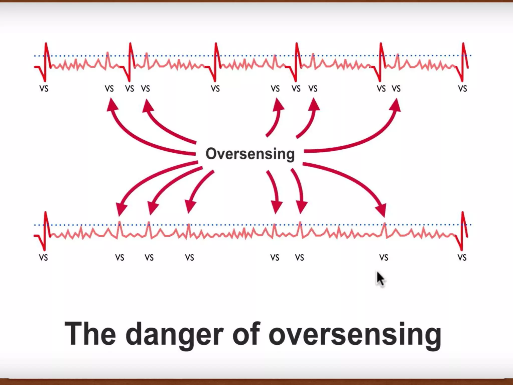 Cardiac Pacemakers - Basics | PPTX