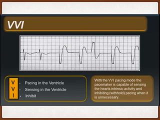 Cardiac Pacemakers Basics Pptx Cardiac Pacemakers Basics Pptx