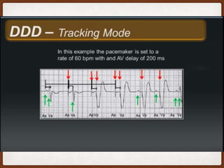 Cardiac Pacemakers Basics Pptx Cardiac Pacemakers Basics Pptx