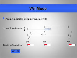 Normal Vvi Pacemaker Mode pacemakerbasics-150910194924-lva1-app6891.ppt