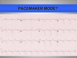 Pacemaker Mode Coding pacemakerbasics-150910194924-lva1-app6891.ppt