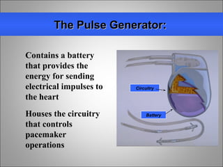 Pulse Generator Pacemaker Real Pacemaker basics | PPT