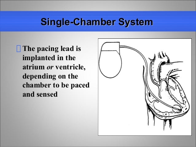 Single chamber vs dual chamber pacemaker
