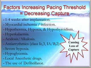 - 1-4 weeks after implantation.
- Myocardial ischemia / infection.
- Hypothermia, Hypoxia, & Hypothyroidism.
- Hyperkalaemia.
- Acidosis/Alkalosis.
- Antiarrythmics (class Ic,3, IA/B,2).
- Severe hypoxia.
- Hypoglycemia.
- Local Anesthetic drugs.
- The use of Defibrillator.
 